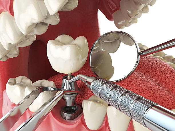 Best Emergency Treatment for Dental Infections or Abscesses in Independence, LA